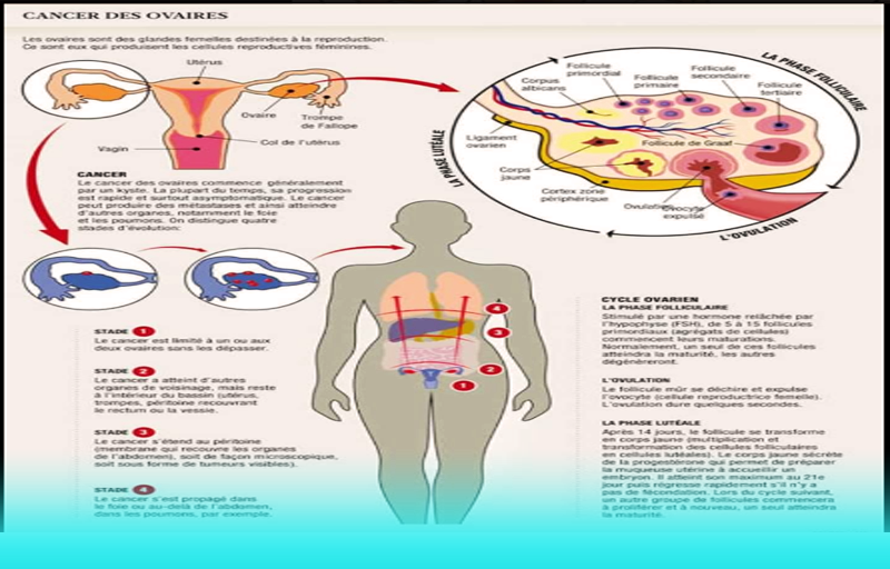 Témoignage Cancer Des Ovaires Stade 3c Santé